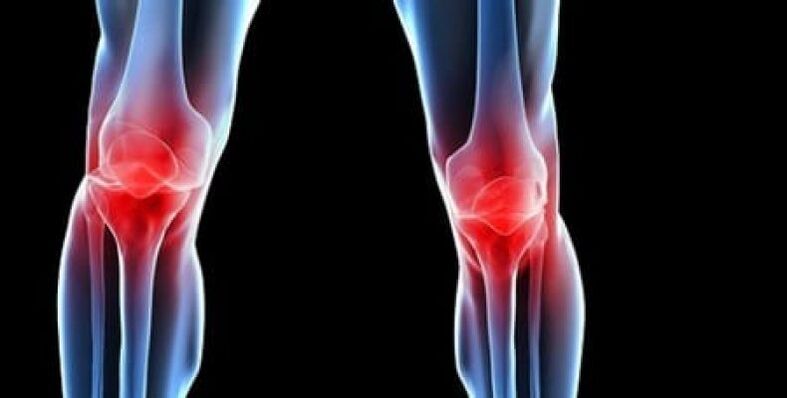 a térd kezelésének deformáló osteoarthritisének jelei